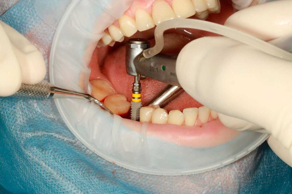Как проходит зубная имплантация