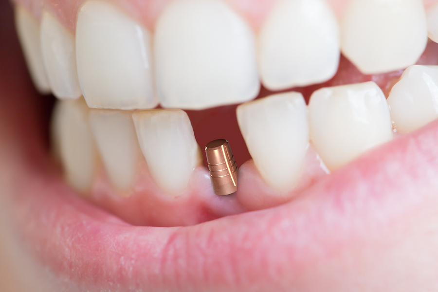 Зубные импланты: что нужно знать